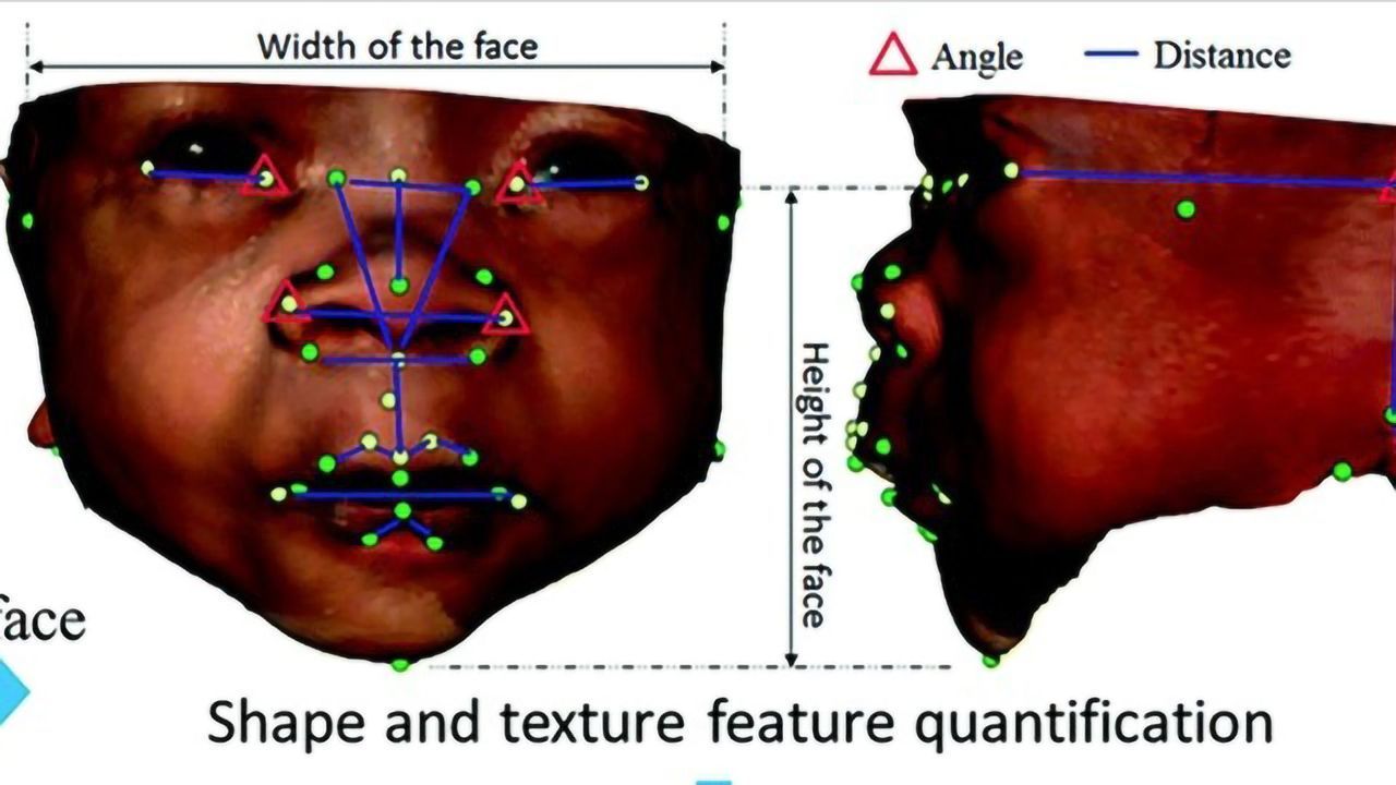 Detecting Genetic Syndromes With Facial Analysis