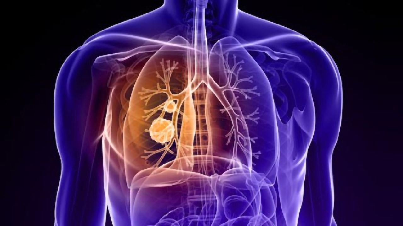 Collaboration Aims To Improve Efficacy of Lung Cancer Drug