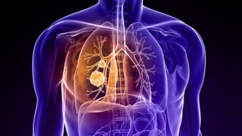 Collaboration Aims To Improve Efficacy of Lung Cancer Drug