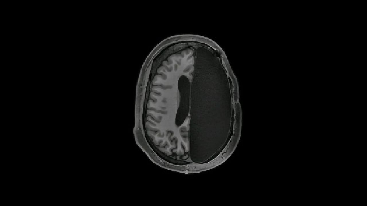 How Do You Get By With Half a Brain? Pretty Well, It Turns Out