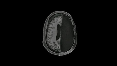 How Do You Get By With Half a Brain? Pretty Well, It Turns Out
