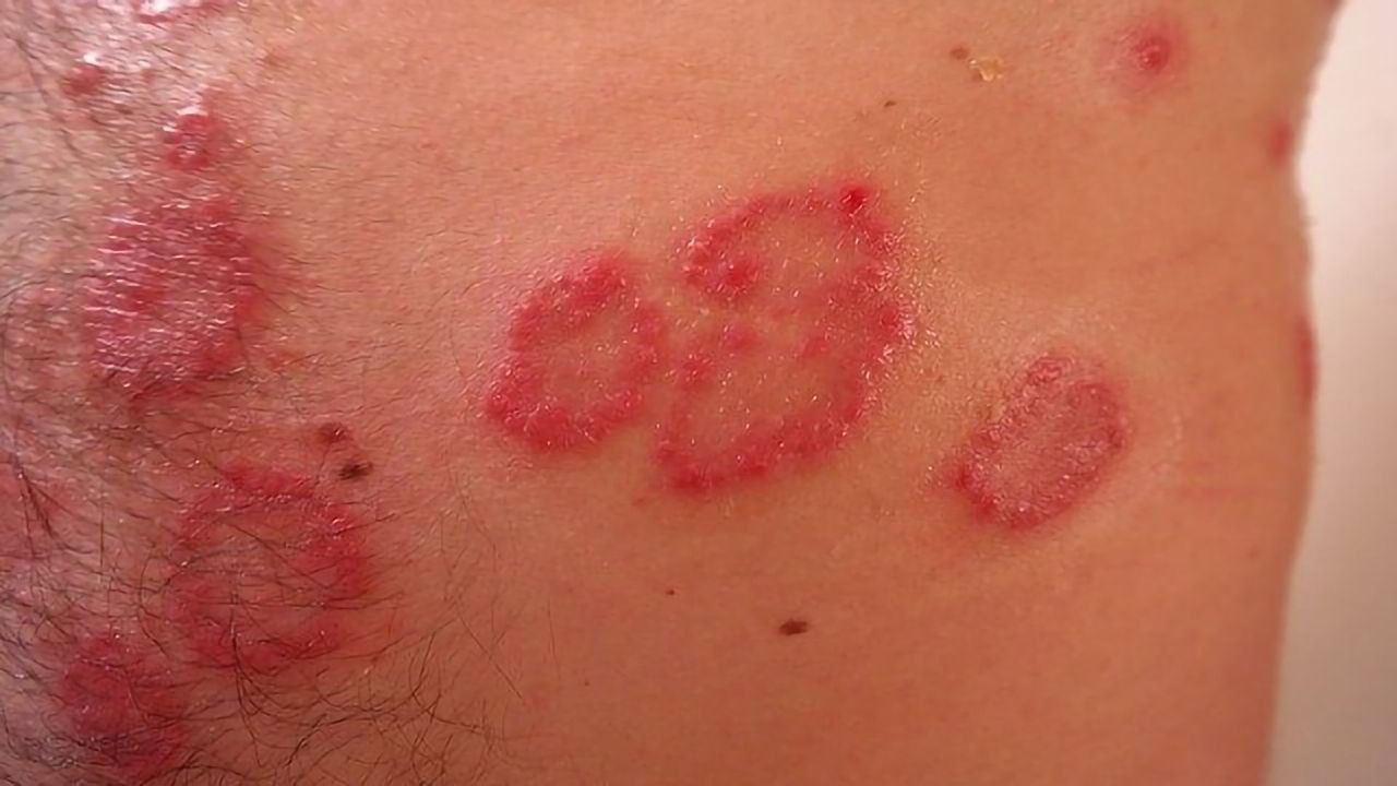 Psoriasis May Be Triggered by Genetic Changes in Skin Stem Cells