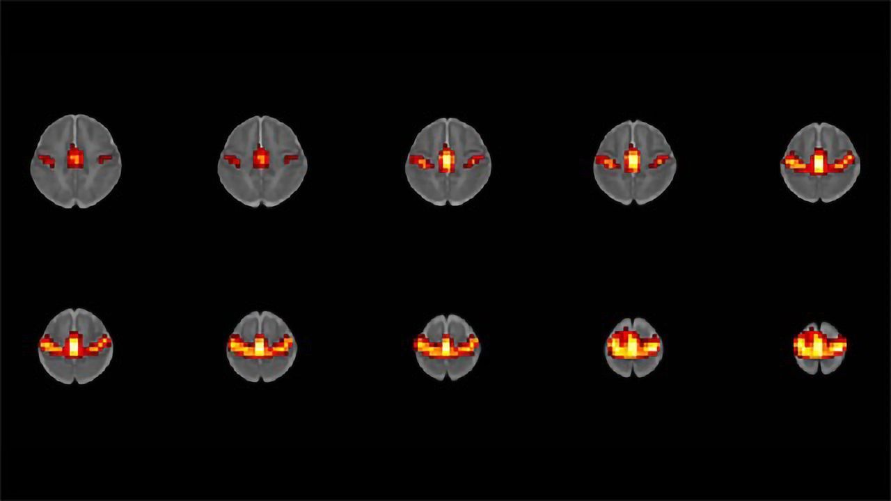 Prenatal Opioid Exposure May Alter Babies' Brain Function