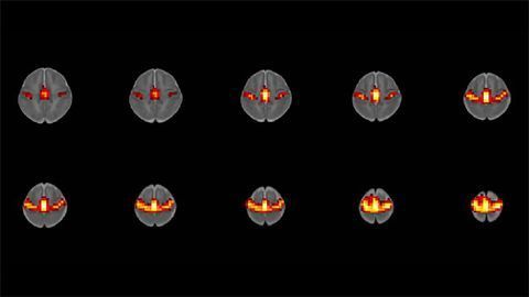 Prenatal Opioid Exposure May Alter Babies' Brain Function
