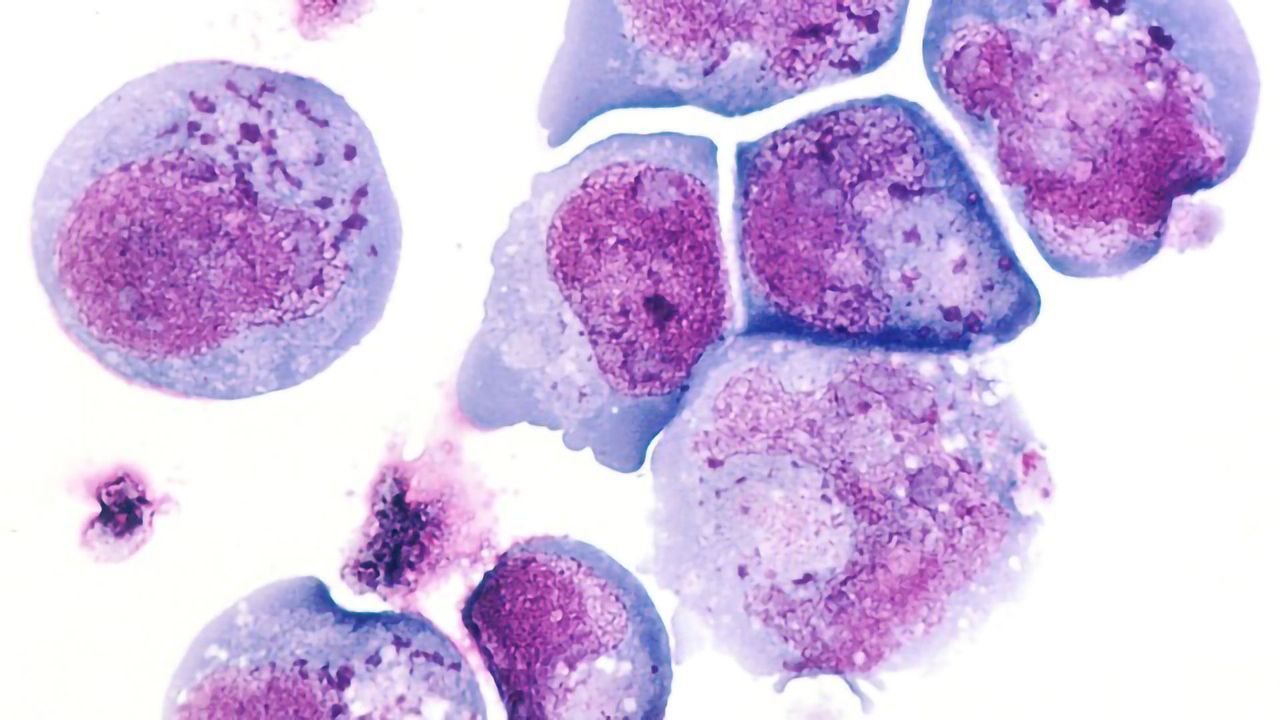 Herpes Virus Variant Linked to MS Onset