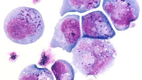 Herpes Virus Variant Linked to MS Onset