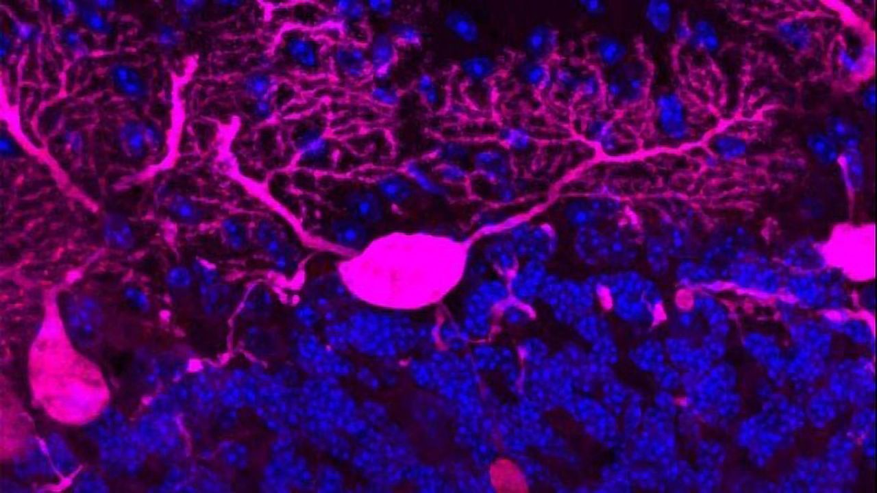 Neuronal Traffic Jam May Influence Neurodegenerative Disease