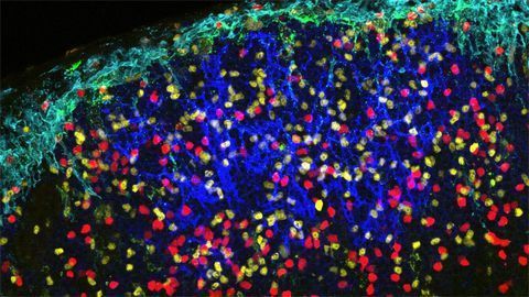 Immune Cell Acts as Shuttle To Spread HIV Around the Body