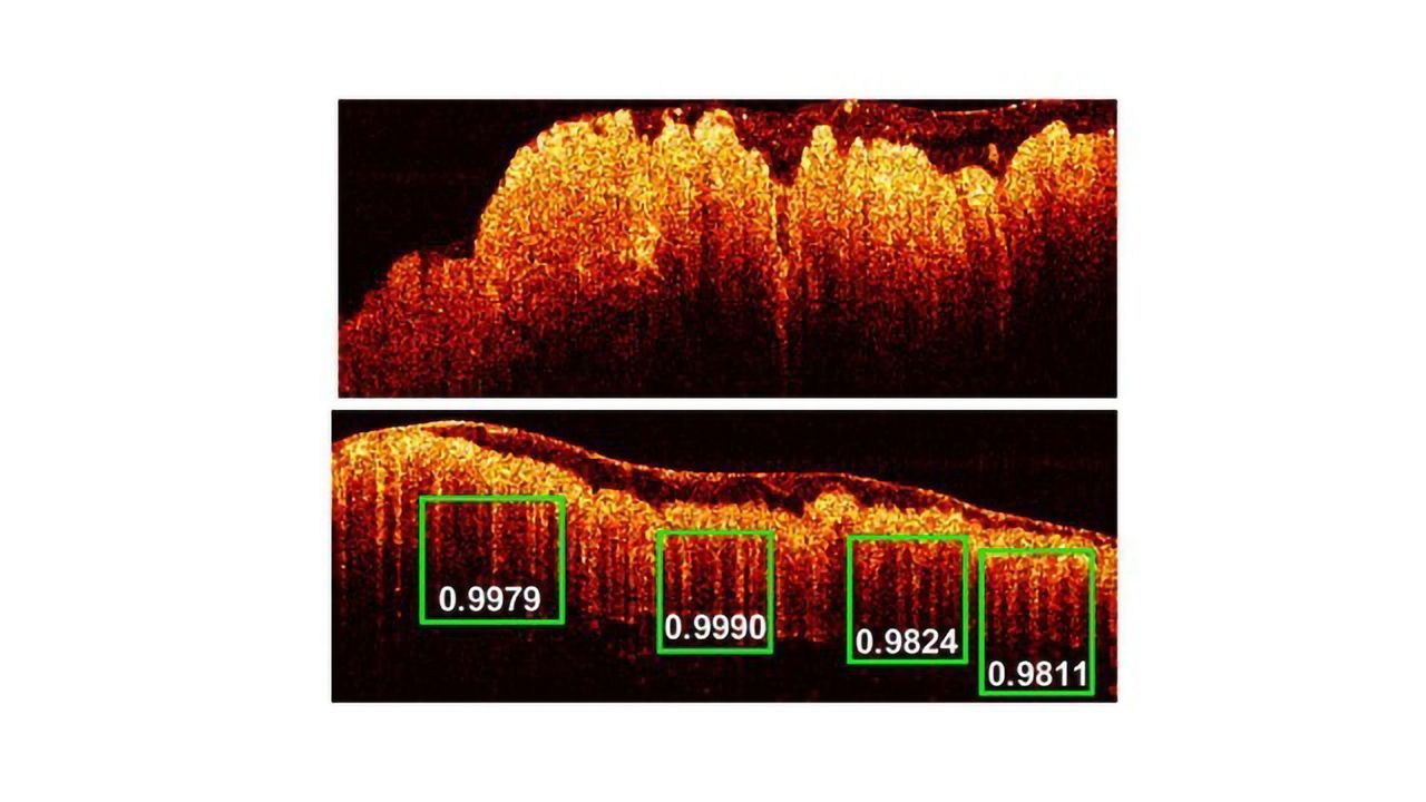 Deep Learning Tool Powers Accurate Diagnosis of Colorectal Cancer