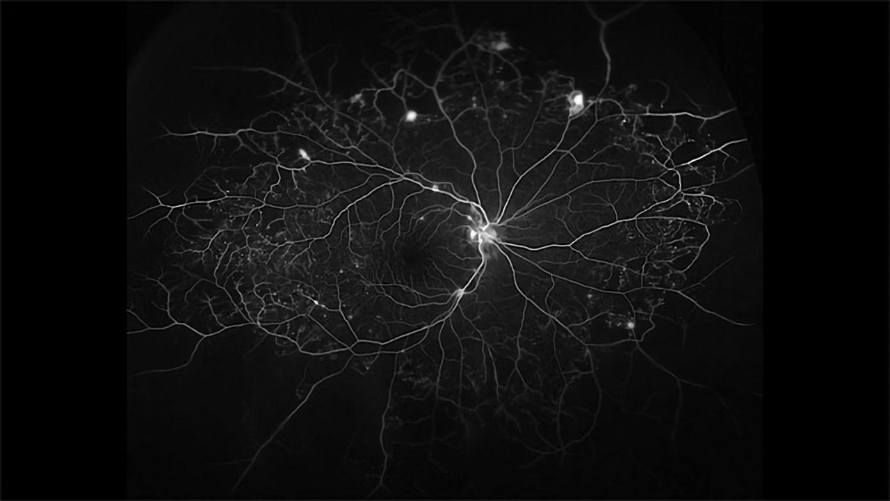 Blood Vessels in the Eye
