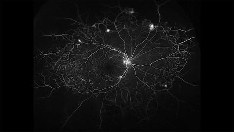 Blood Vessels in the Eye