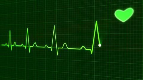 Better Understanding of Irregular Heartbeat May Lead to Improved Treatment