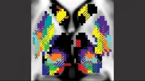 Why Doesn't Deep Brain Stimulation Work for Everyone?