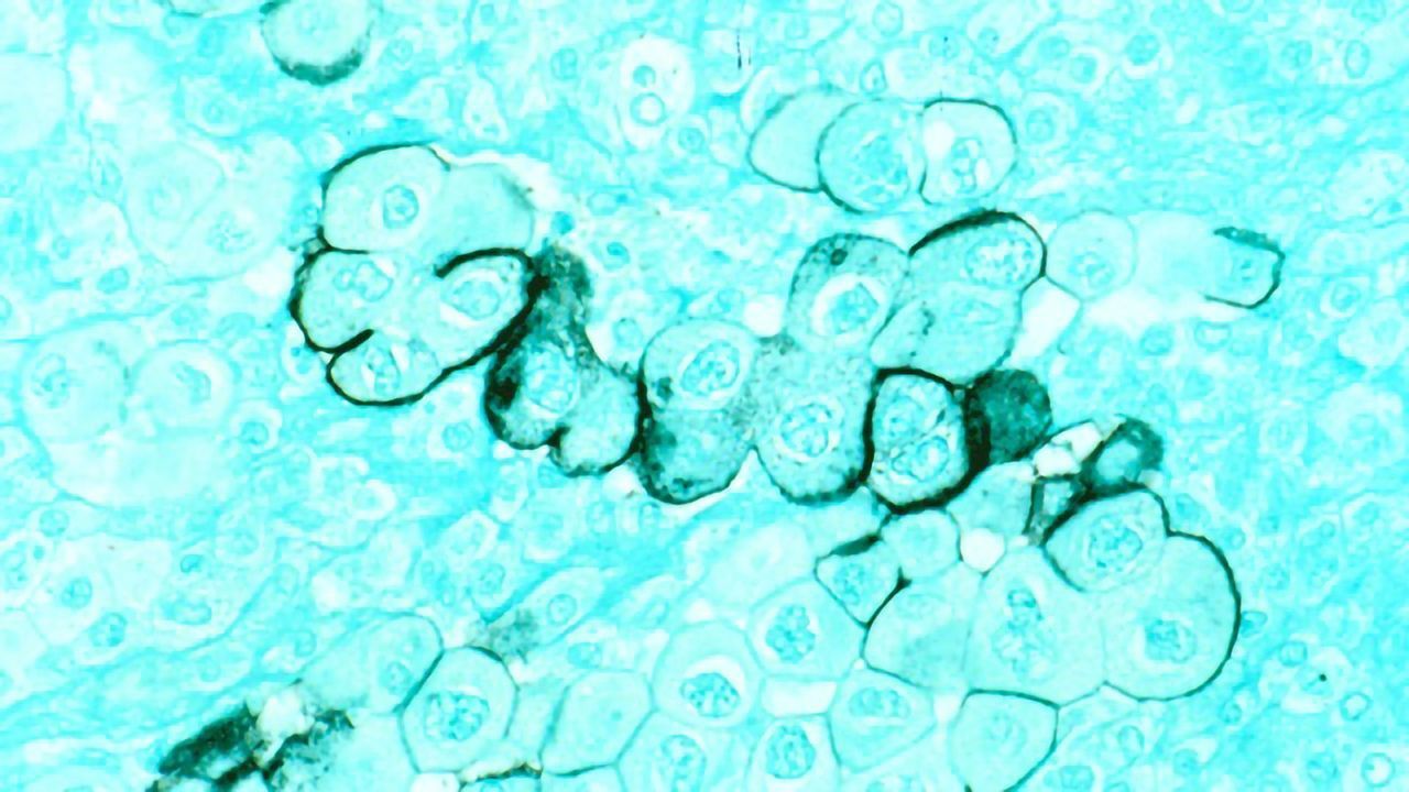 Study Reveals How Pancreatic Cancer Cells Avert Starvation