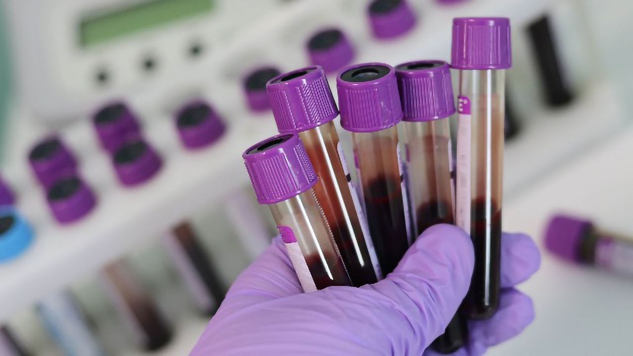 Standard Pathology Tests Outperform Molecular Subtyping in Bladder Cancer