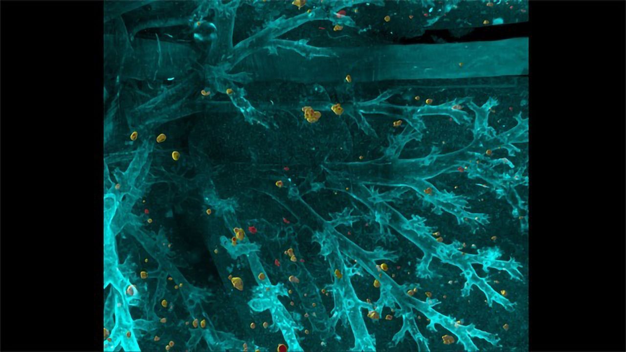 Detecting Cancer Using AI