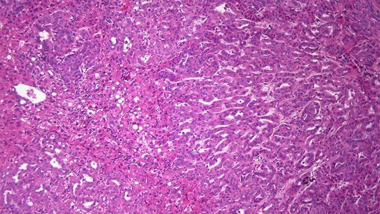 Transcriptomic Switch Turns Healthy Liver Tissue Cancerous