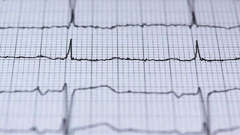 Scientists Take Stem Cells and Convert Them to Heart Pacemaker Cells