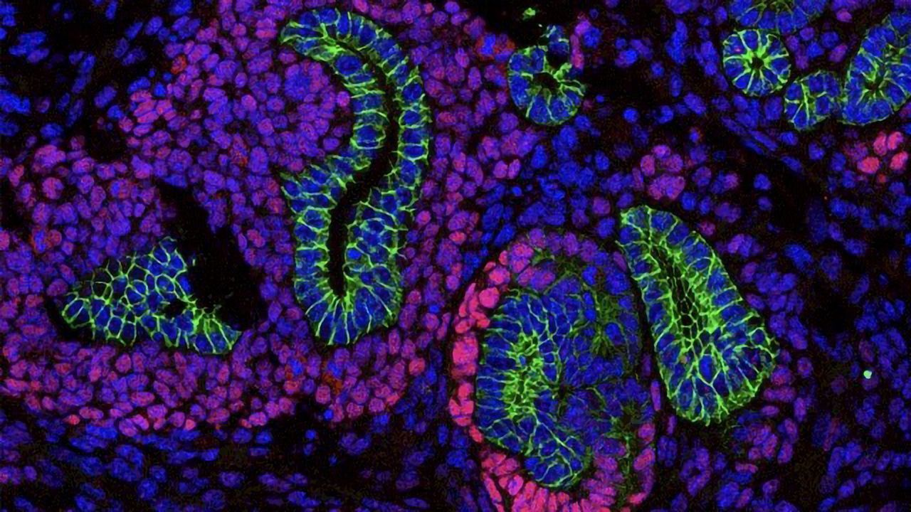 Novel Mechanism in Childhood Kidney Cancer