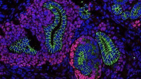 Novel Mechanism in Childhood Kidney Cancer
