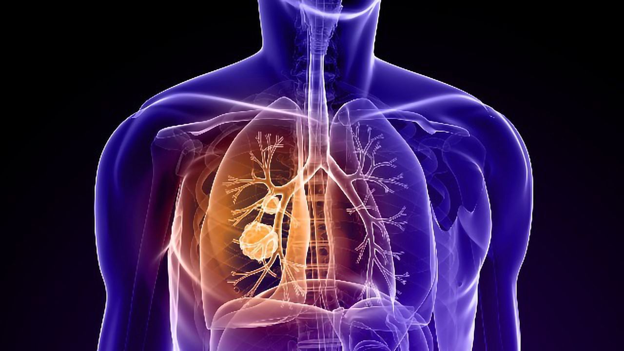 First-in-Human Trial for Novel Lung Cancer Immunotherapy