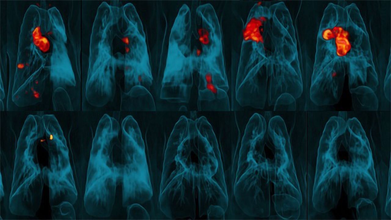 TB Vaccine Efficacy Greatly Improved by Changing How It Is Administered