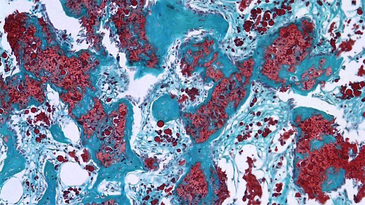 Heparin Microparticles at Work
