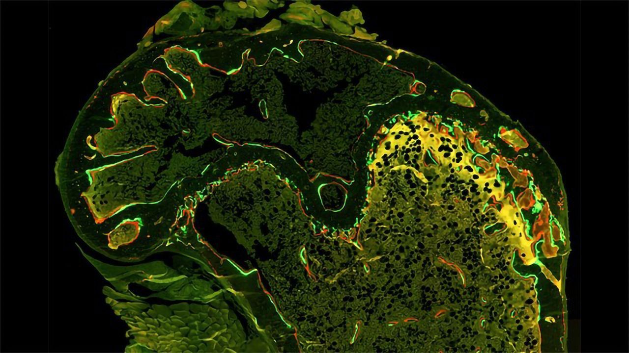 Bone Loss During Cancer Treatment