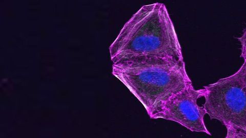 A Way To Tackle Drug Resistance in Skin Cancer Cells