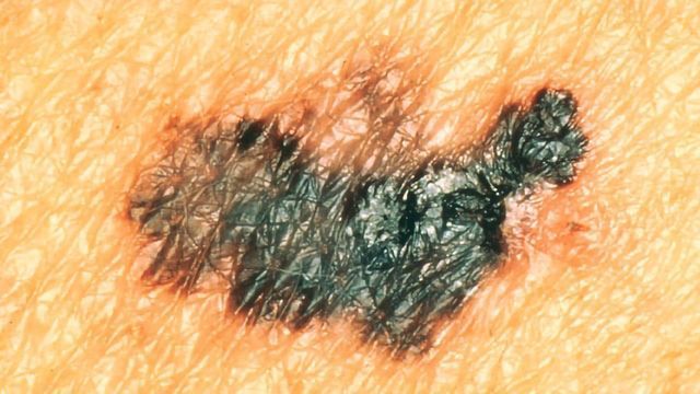 Skin Cancer Suppressor Uncovered content piece image 