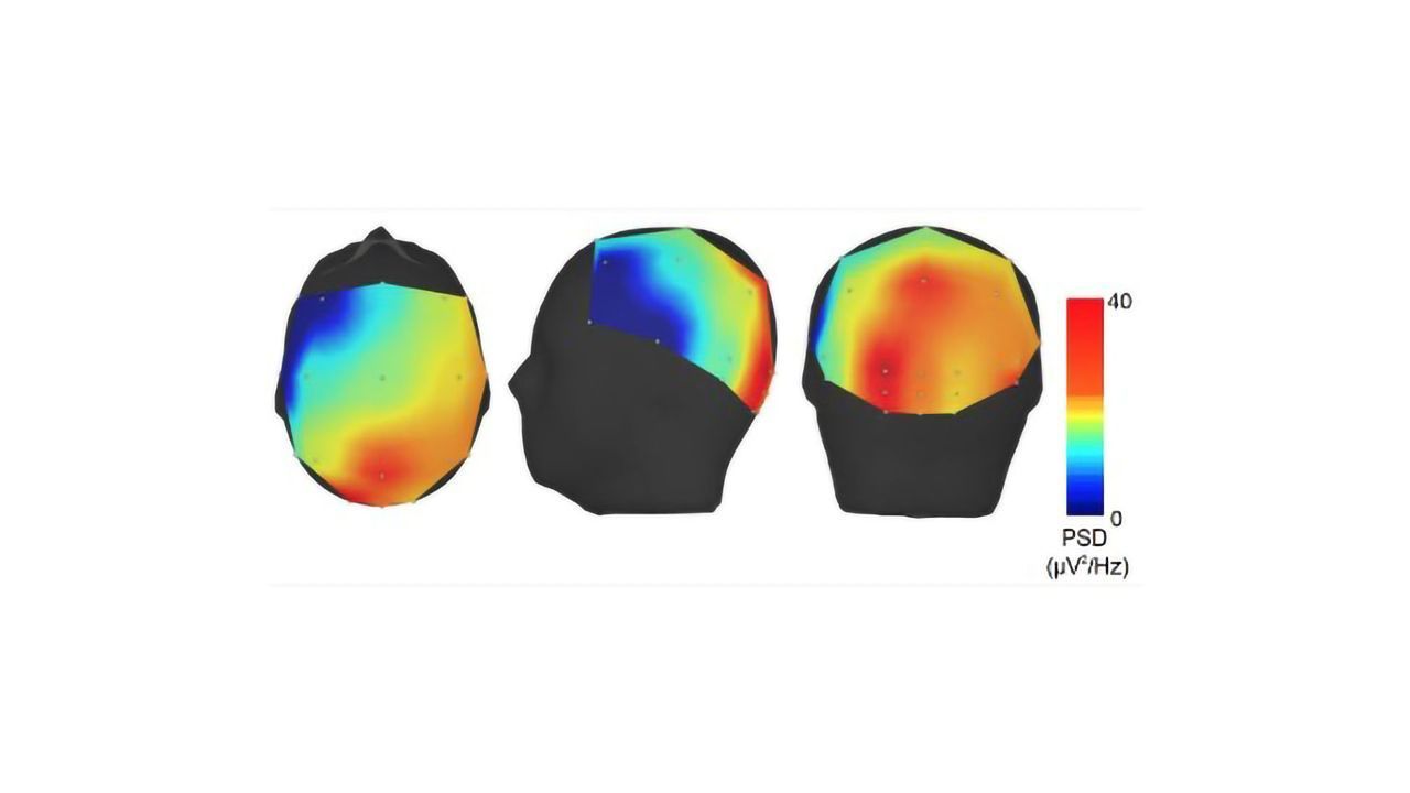 Could Essential Tremor Be Caused by Overactive Brain Waves?