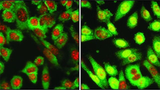 Protein "Switch Off" Makes Breast Cancer More Aggressive content piece image 