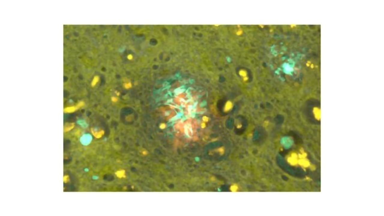 Aluminum Exposure Again Linked to Alzheimer's Disease