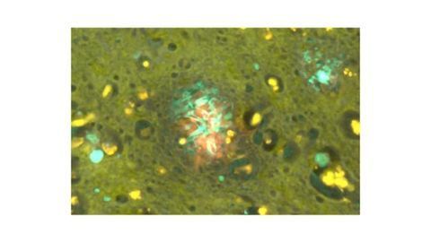 Aluminum Exposure Again Linked to Alzheimer's Disease