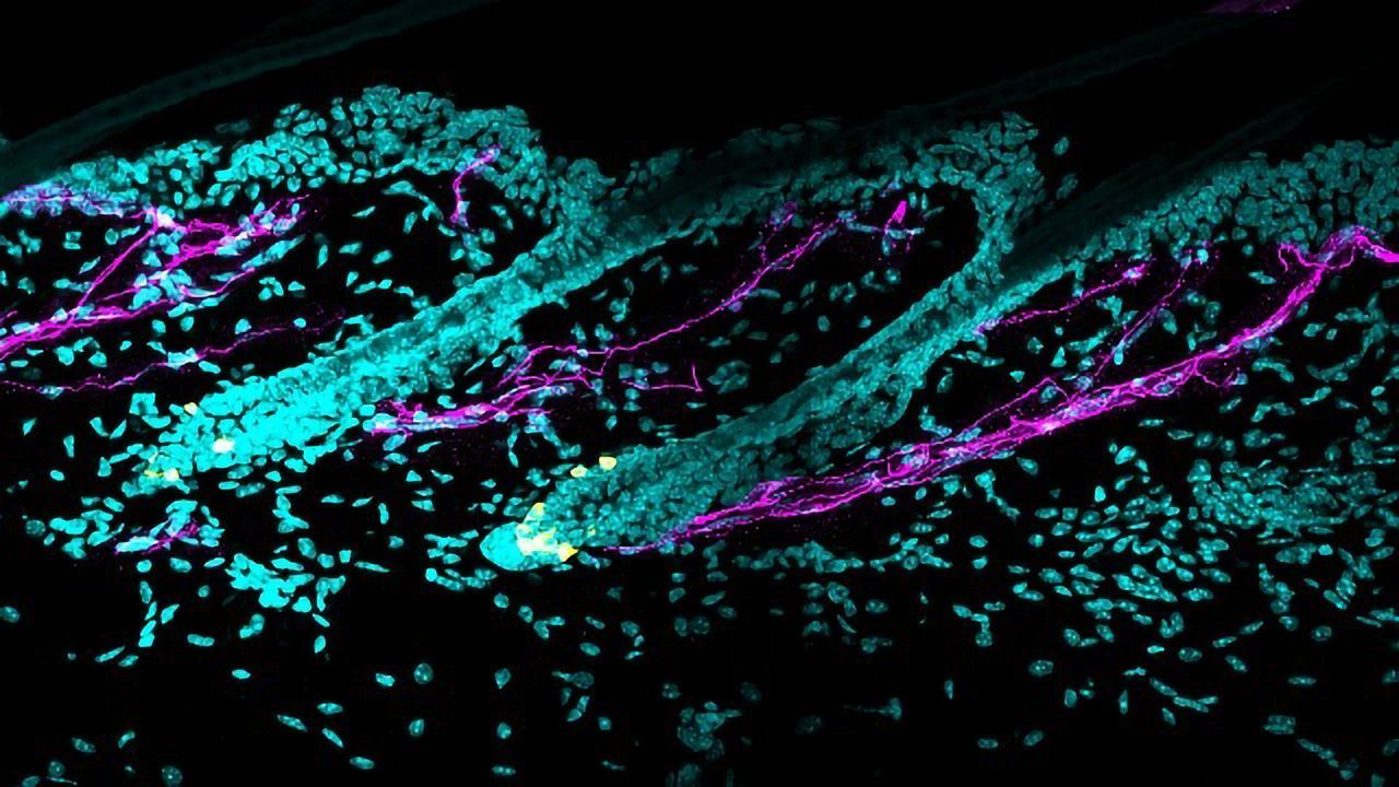 Why Does Stress Turn Hair Gray? Nerve Study Provides the Answer