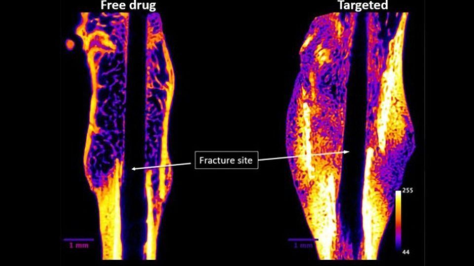 Drug for Faster Healing of Bone Fractures Set for Clinical Trials content piece image