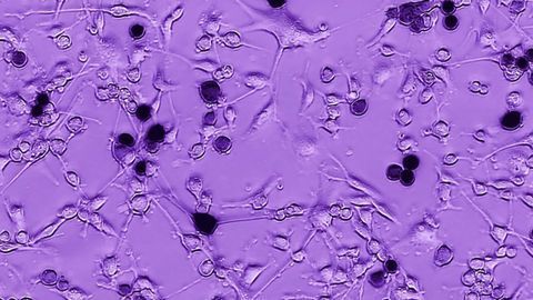 Ebola – An Unlikely Ally in the Fight Against Brain Tumors
