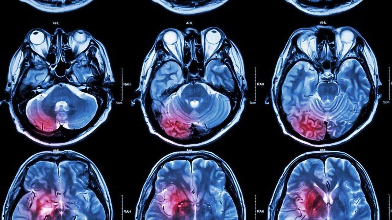 Drug Combo for Childhood Brain Tumors Shows Promise in Lab Models