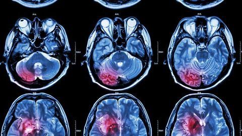 Drug Combo for Childhood Brain Tumors Shows Promise in Lab Models