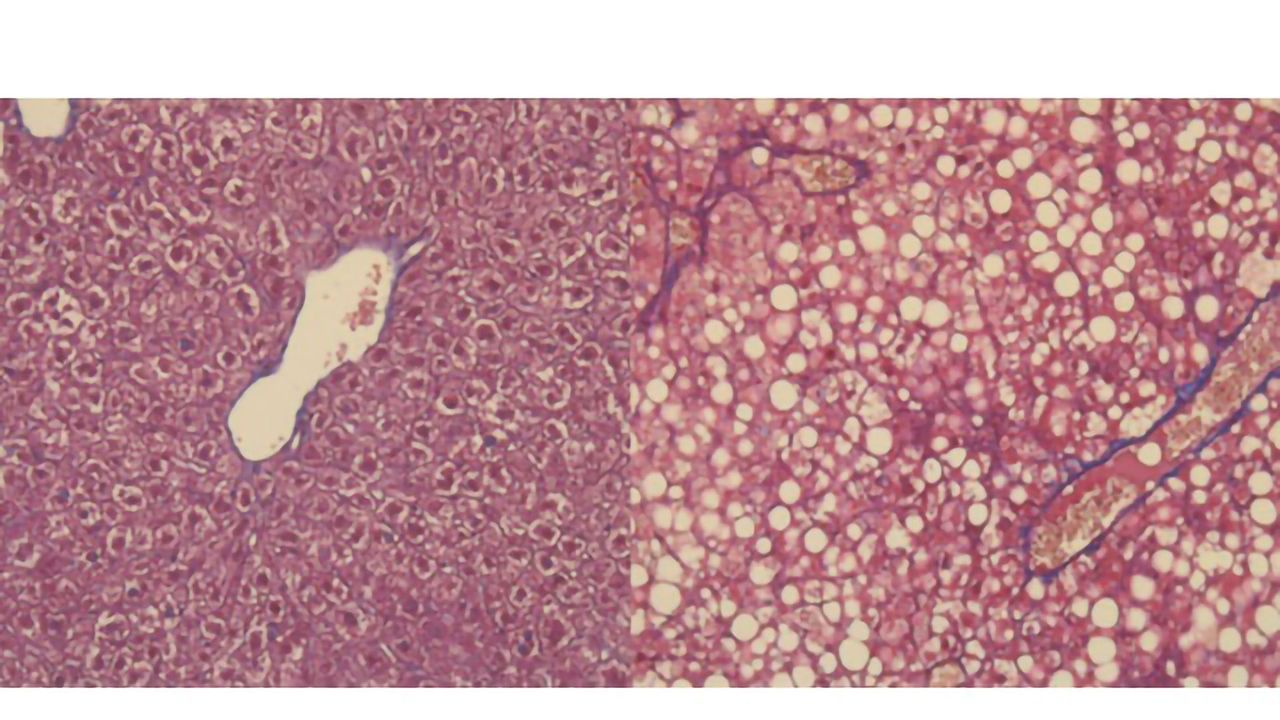 Protein Participates in Shift From “Fatty Liver” to Cancer