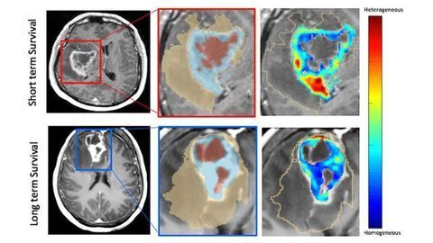 Strategies Developed To Understand and Combat Brain Cancer