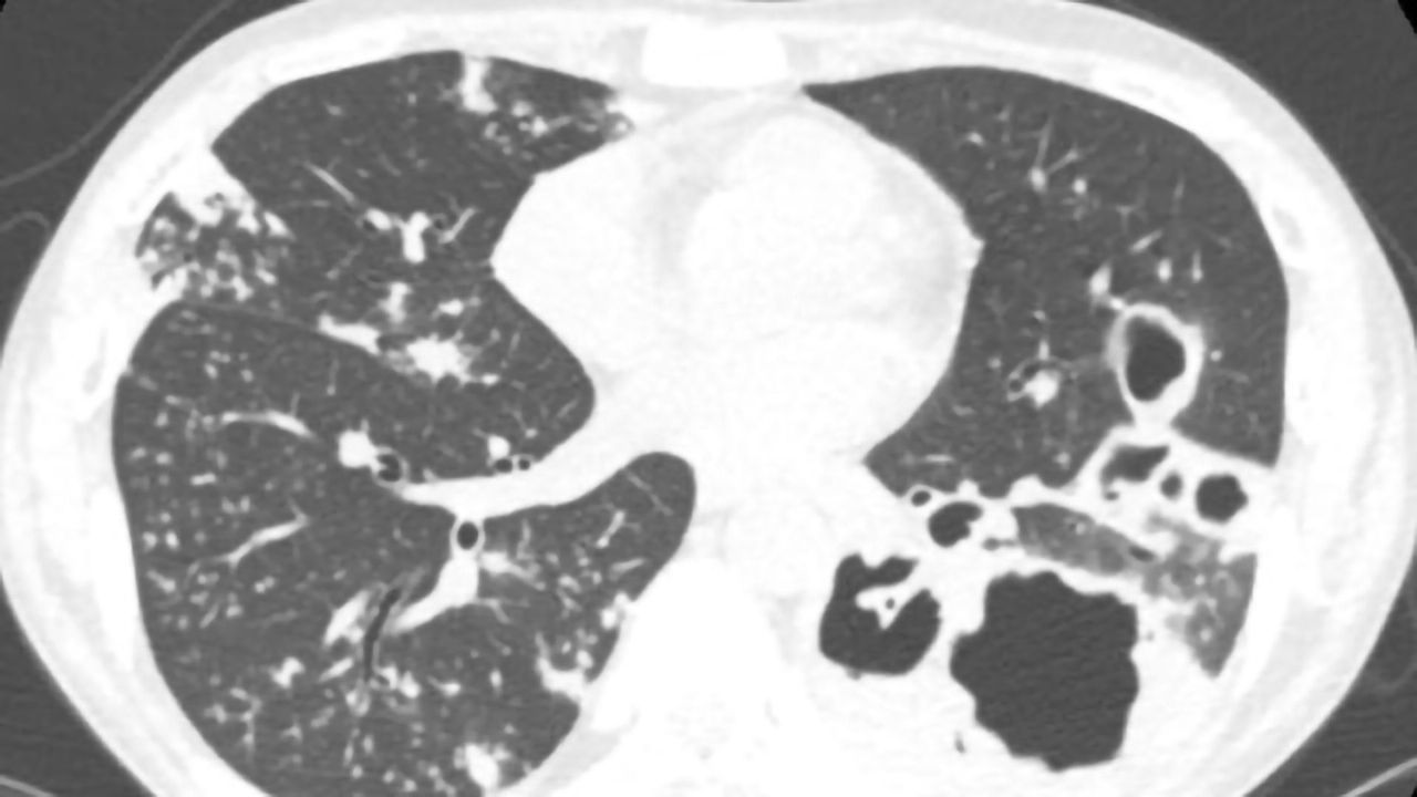 Checkpoint Inhibitors for Cancer Can Activate TB Infection