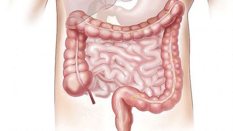 Why Is Colon Cancer More Deadly in Patients Under 25 Years?