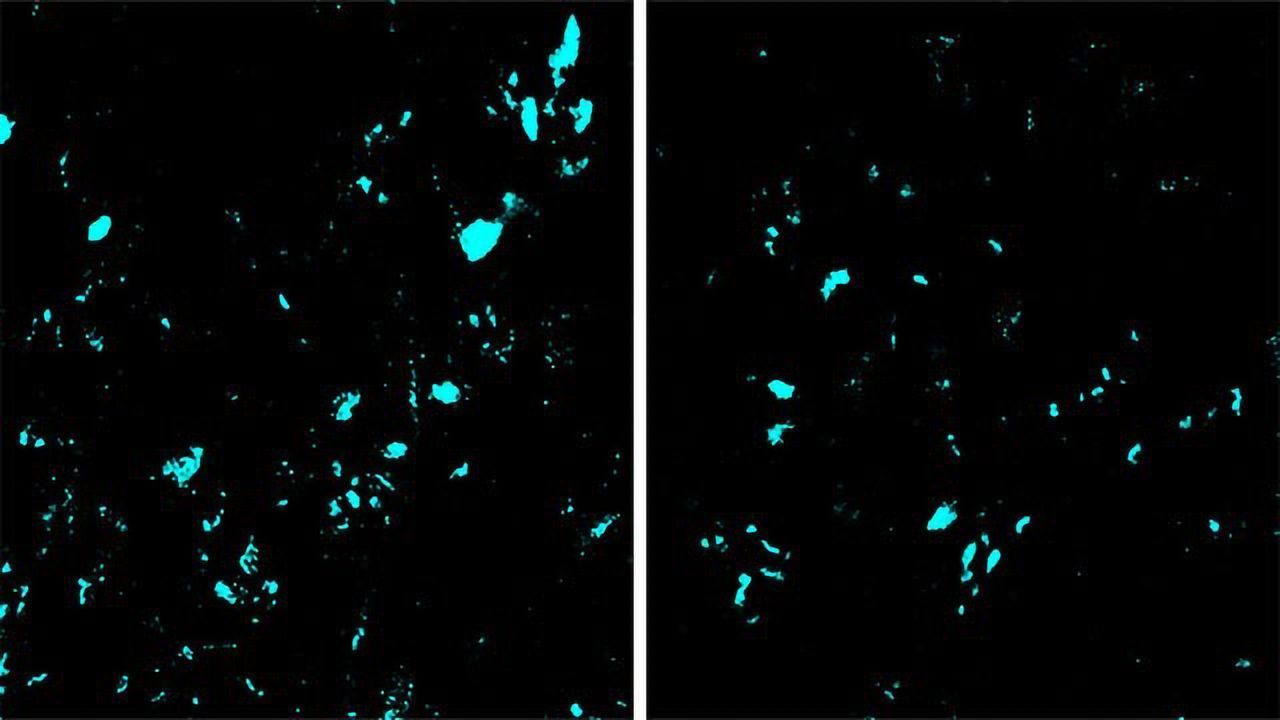 New CRISPR Gene-editing Technology Slows ALS Progression