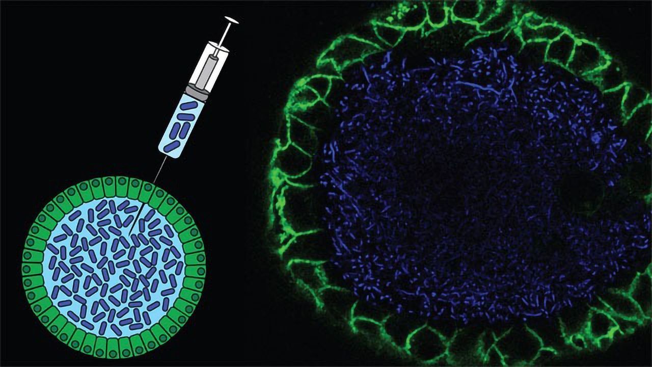 Bacteria Found in Our Guts Could Contribute to Bowel Cancer
