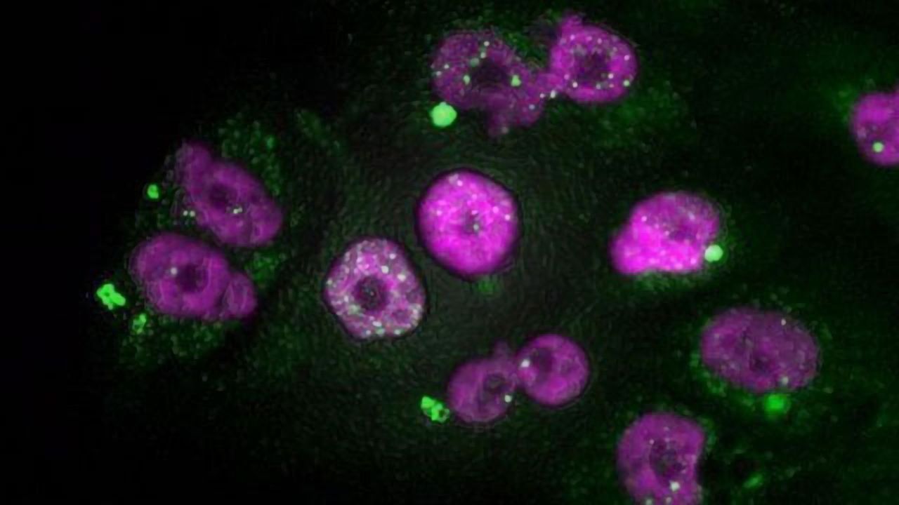 Preventing Aggressive Tumors From Becoming Resistant to Chemotherapy