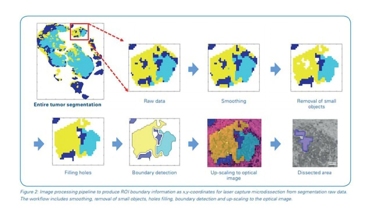 MALDI Guided SpatialOMx Uncovers Proteomic Profiles in Tumor Subpopulations of Breast Cancer