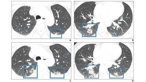 Novel Coronavirus Imaging Shows “Significant Overlap” With SARS and MERS