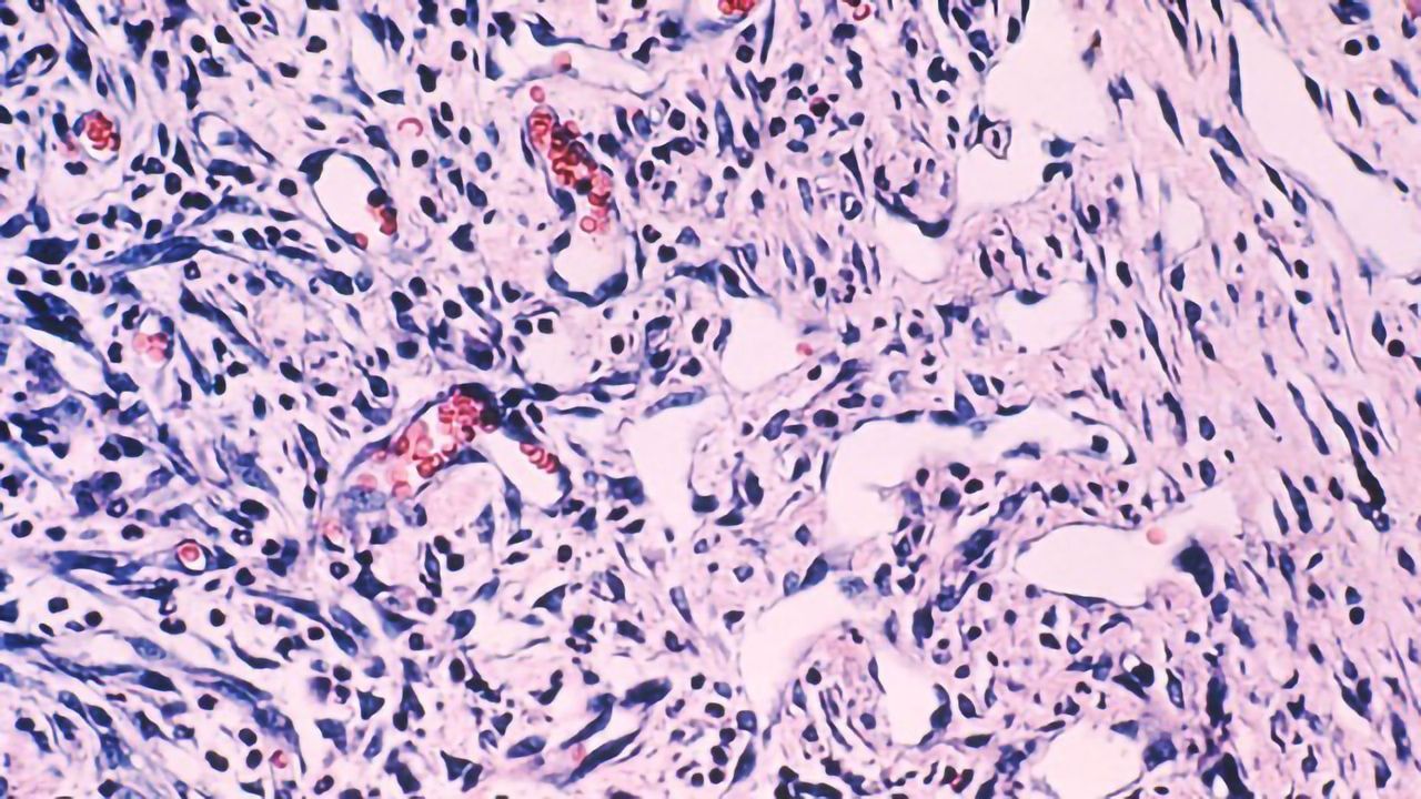 World’s Largest Sarcoma Research Database Aims To Revolutionize Treatment