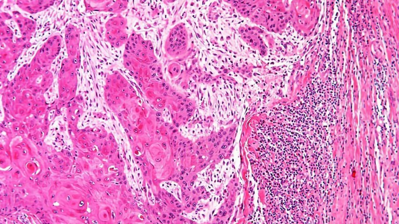 Drug Could Improve Cancer Immunotherapy Success